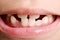 Child missing front teeth