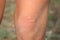 The child`s knee burned with nettle grass. Type of burn