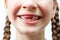 In the child`s mouth, two upper front milk teeth were torn out