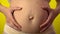 After childbirth and pregnancy, close-up of a woman belly skin with heavy stretch marks and stretched skin - Health care