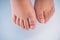 Children foot with a cracked and peeling toe nail on the largest toe. Toenail Fungus