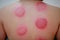 Chinese medicine science is a method of treatment using Cupping.