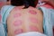 Chinese medicine science is a method of treatment using Cupping.