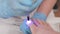 Chiropodist installs a titanium thread on the big toe and using UV gadget. Correction of ingrown toenail. Pan shot. The