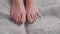 Chiropody. Close-up of the female feet with a bracket on the nail. Correction of ingrown toenail. The concept of