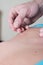 Chiropractor using acupuncture needle on patient