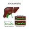 Cholangitis. Cross section of the human liver, bile duct, and ga