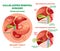 Cholecystectomy - Gallbladder removal surgery, anatomical vector illustration diagram with operative conditions.