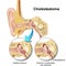 Cholesteatoma human ear anatomy  illustraton on white background