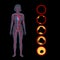 Cholesterol and atherosclerosis