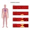 Cholesterol and atherosclerosis