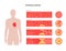 Cholesterol heart disease