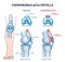 Chondromalacia patella knee breakdown compared with healthy outline diagram