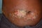 Chronic dermatitis or fungal infection in abdomen of Asian man