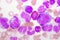 Chronic myeloid leukemia cells