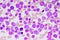 Chronic myeloid leukemia cells or CML
