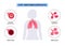 Chronic obstructive pulmonary disease