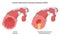 Chronic obstructive pulmonary disease. Chronic inflammatory lung disease