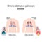 Chronic obstructive pulmonary disease COPD