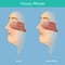 Chronic Rhinitis. This illustration medical use for explain comparison chronic rhinitis symptoms have mucus in the nose