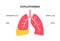 Chylothorax anatomical poster