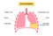 Chylothorax anatomical poster