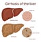 Cirrhosis of the liver