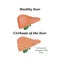 Cirrhosis of the liver. Vector illustration on background