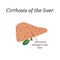 Cirrhosis of the liver. Vector illustration on background
