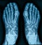 Classic x-ray image of human feet