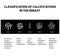 Classification of calcifications in the mammary gland. Mammography. The mammary gland. Infographics. Vector