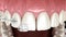 Clear braces instalation other teeth