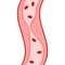 Clogged Artery with platelets and cholesterol plaque. Cholesterol: Types, Importance, Prevention and Treatment. Disease Control.