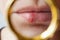 close female lips affected by herpes simplex virus, swelling and blisters on the lips