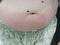 Close up, abdominal skin area, moles and rashes, redness, allergies, itching, pregnant women, Asian teenagers