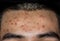 Close up of Acne on the skin, Acne on the face caused by Hormone
