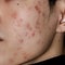 Close up of Acne on the skin, Acne on the face caused by Hormone