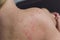 Close up Allergy rash, Around Back view of human with dermatitis problem of rash ,Allergy rash and Health problem.