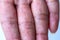 Close up Atopic dermatitis on fingerAD, also known as Atopic eczema.Skin disease concept.