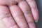 Close up Atopic dermatitis on fingerAD, also known as Atopic eczema.Skin disease concept.