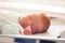 Close-up of a baby in ICU with nose tube feeding