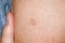 Close up of Bacillus Calmette-GuÃ©rin BCG vaccine scar mark in the upper left arm of an adult person; BCG vaccine is usually