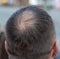 Close-up of a bald spot on a man& x27;s head.