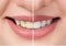 Close up beautiful teeth before and after whitening or bleaching, health dental care beauty clinic concept.