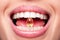 Close Up Of Beautiful Woman Opened Mouth Holding Fish Oil Pill In White Teeth. Smiling Girl Holding Capsule With Omega-3 Between
