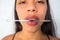 Close-up of a beautiful young woman`s face with a syringe in her mouth. Injection of hyaluronic acid collagen to correct, pamper