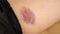 Close-up of blue and pink bruise on woman`s thigh