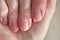 Close-up of brittle nails on woman& x27;s hands. Female broken fingernail.