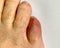 Close up on the broken little toe of a senior man