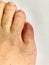 Close up on the broken little toe of a senior man